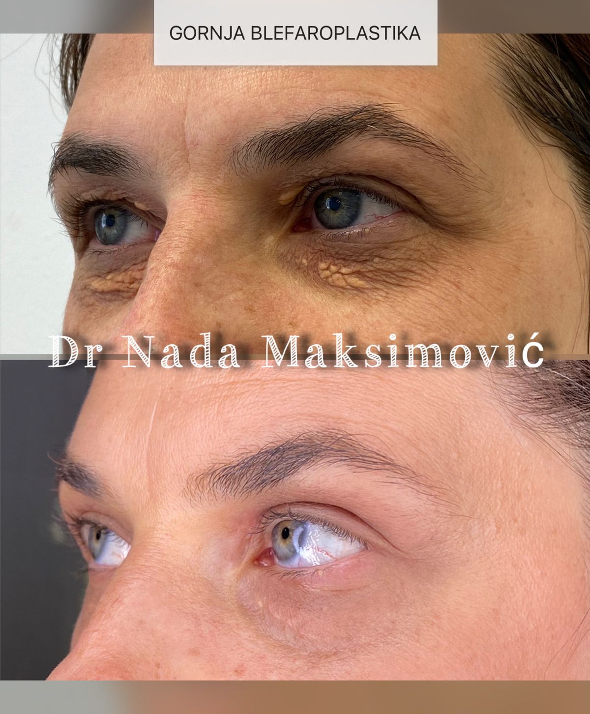 Gornja blefaroplastika — očni kapci pre i posle operacije, ordinacija dr Nada Maksimović