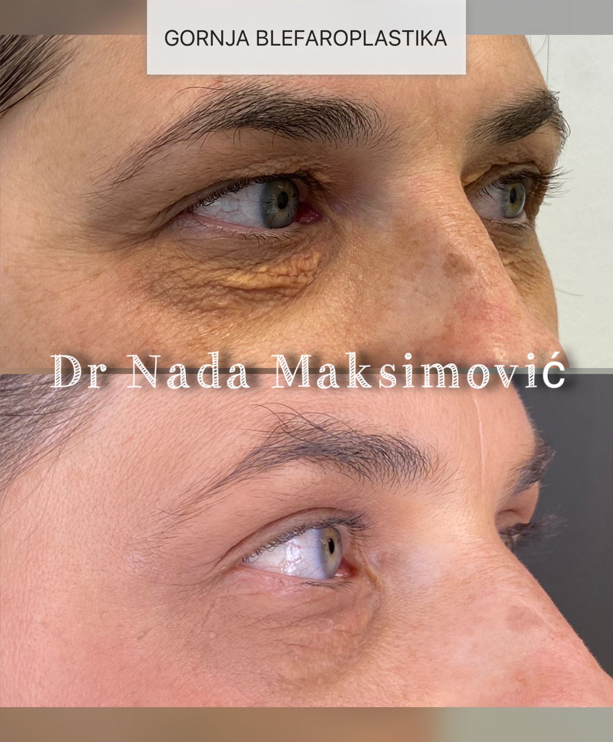 Gornja blefaroplastika iz profila — kapci pre i posle operacije, ordinacija dr Nada Maksimović
