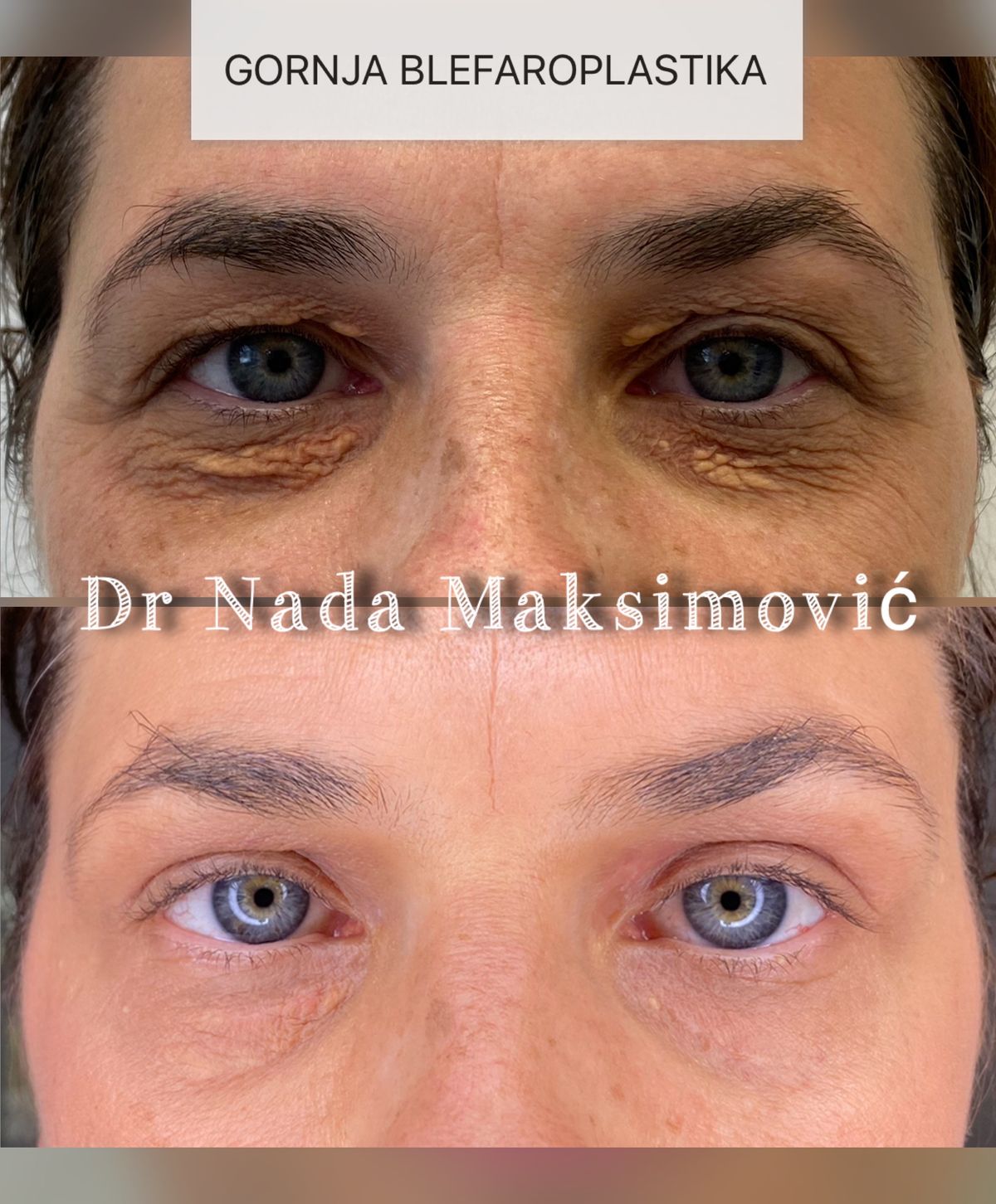 Gornja blefaroplastika, pogled spreda — oba oka pre i posle operacije, ordinacija dr Nada Maksimović