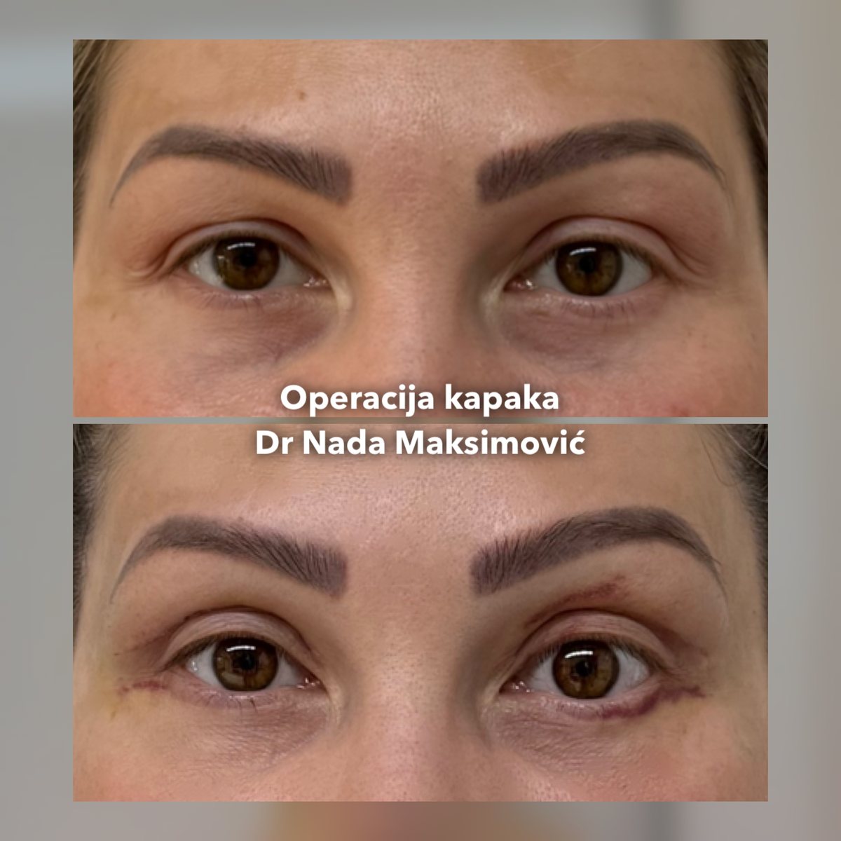 Gornja blefaroplastika, oba oka spreda — pre operacije i neposredno posle, dok su šavovi još vidljivi, ordinacija dr Nada Maksimović