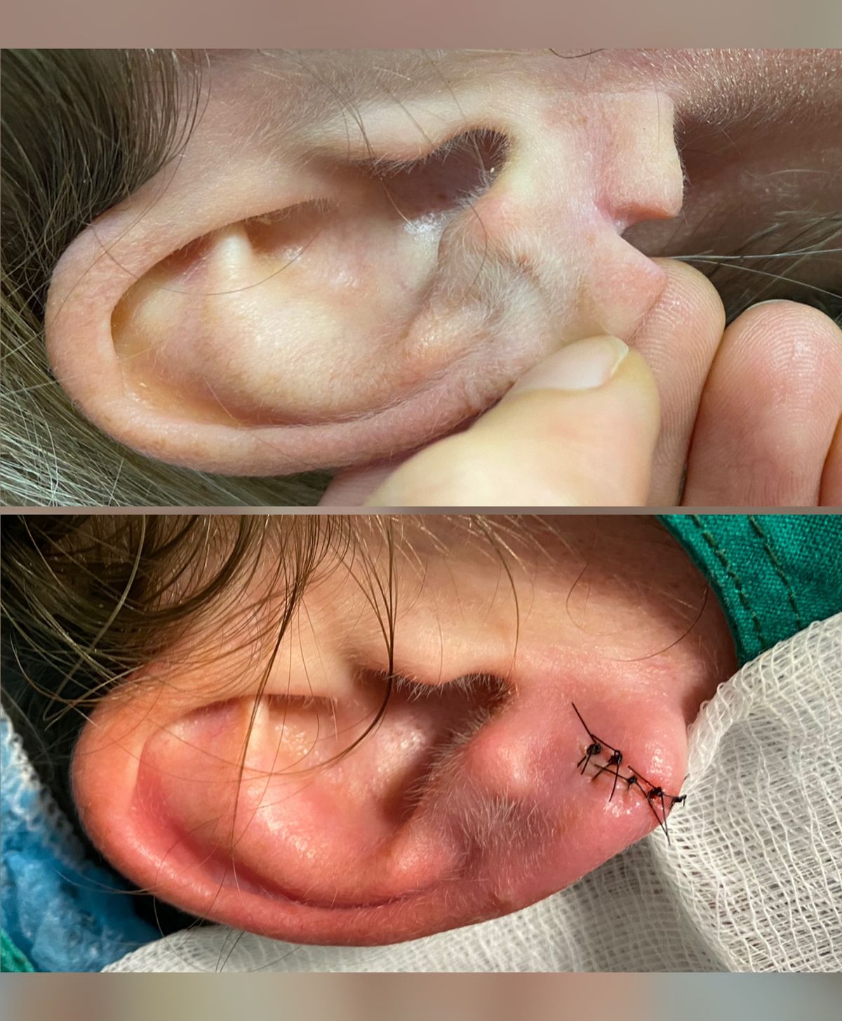 Otoplastika — uvo pre operacije i neposredno posle, sa šavovima, ordinacija dr Nada Maksimović