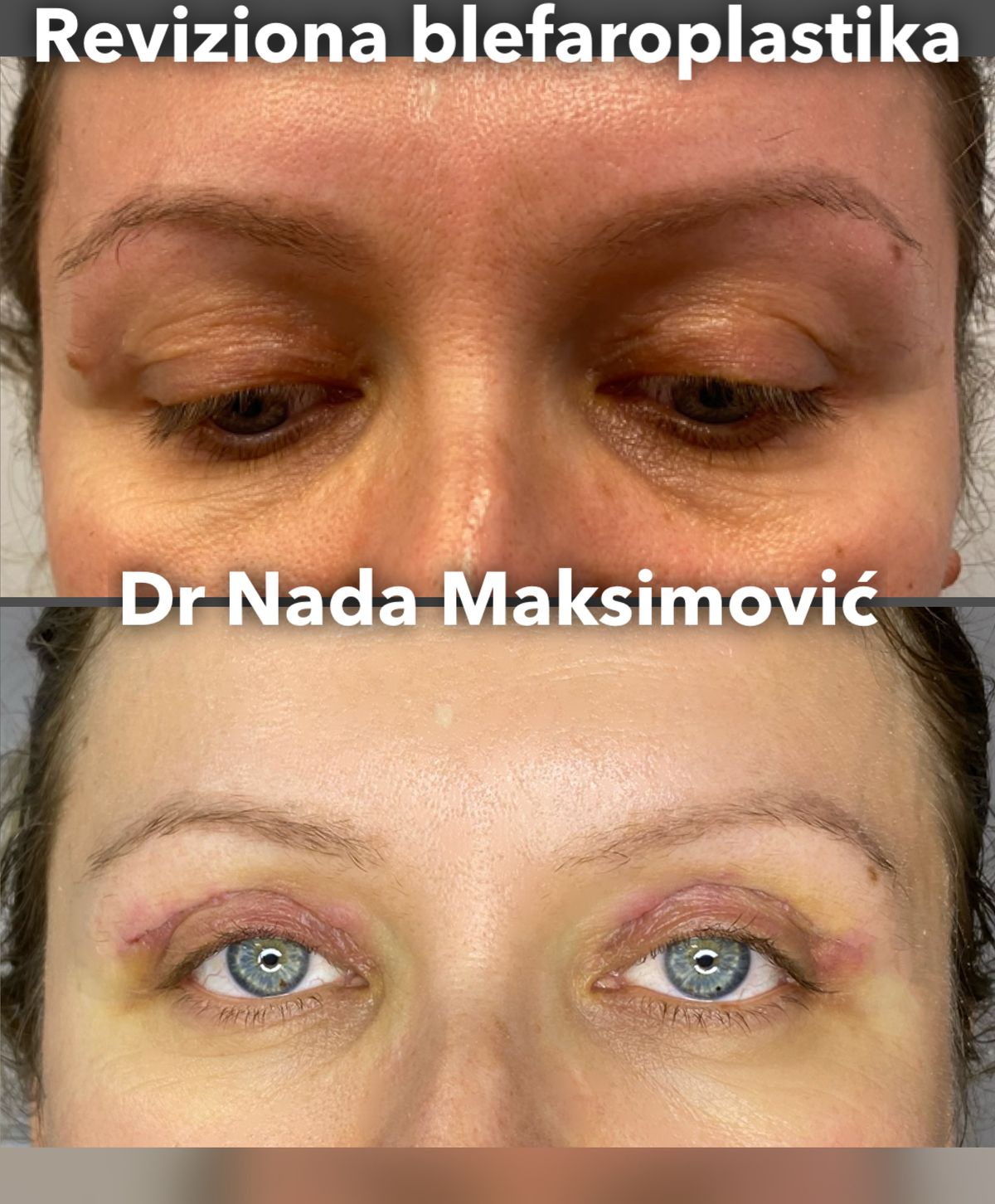 Reviziona blefaroplastika — ispravka ranije operacije kapaka, pre i posle, ordinacija dr Nada Maksimović