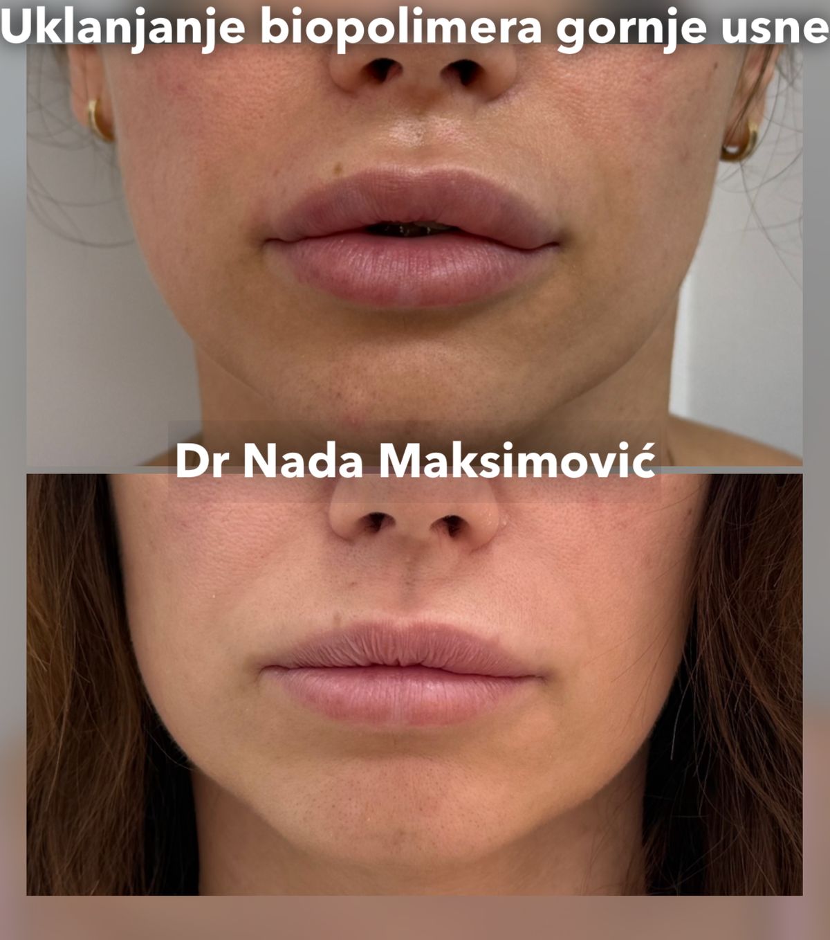 Hirurško uklanjanje biopolimera iz gornje usne — pre i posle, ordinacija dr Nada Maksimović